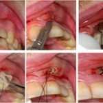Pravočasno zdravljenje vnetja dlesni preprečuje izpadanje zob
